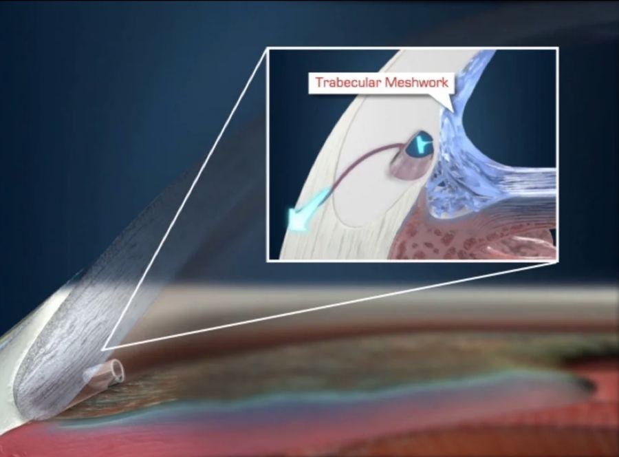 Micro-stent placed in the eye's drainage angle (trabecular meshwork)