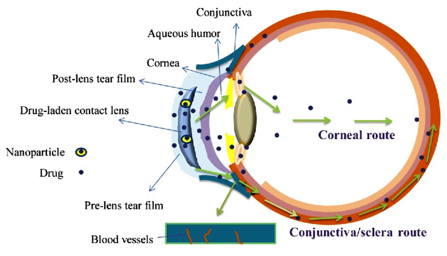 Drug-eluting contact lens for delivering glaucoma medication
