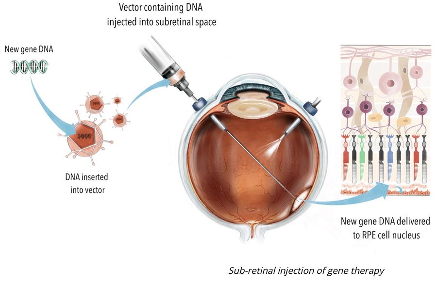 Sub-retinal injection of gene therapy for the eye