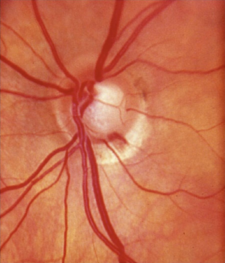 Optic-nerve notching with a splinter hemorrhage in normal tension glaucoma