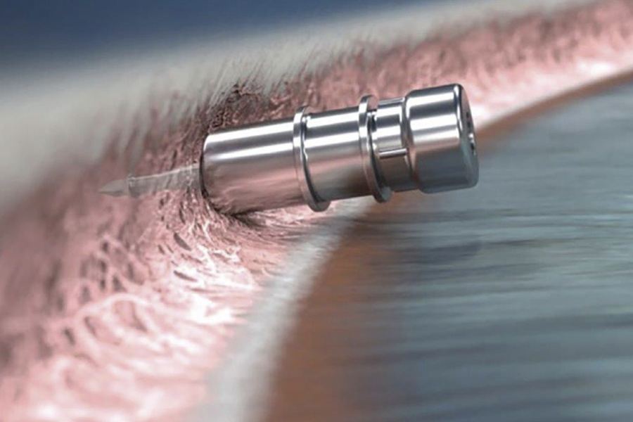 iDose TREX intracameral implant for sustained glaucoma medication delivery