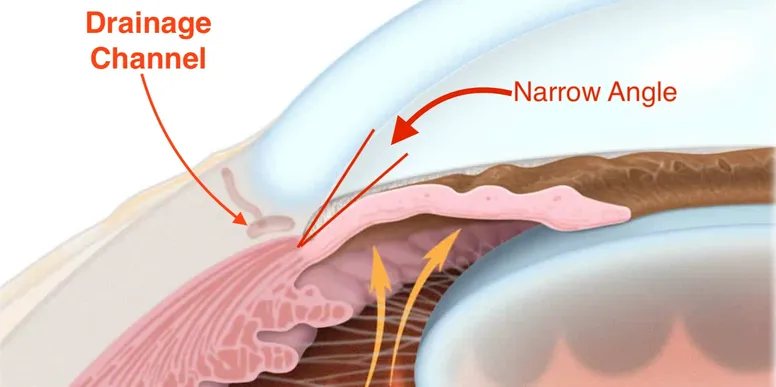 Narrow-Angle Glaucoma