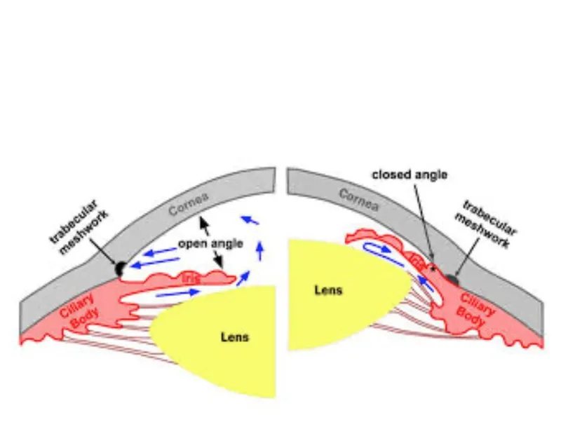 Open-Angle Glaucoma