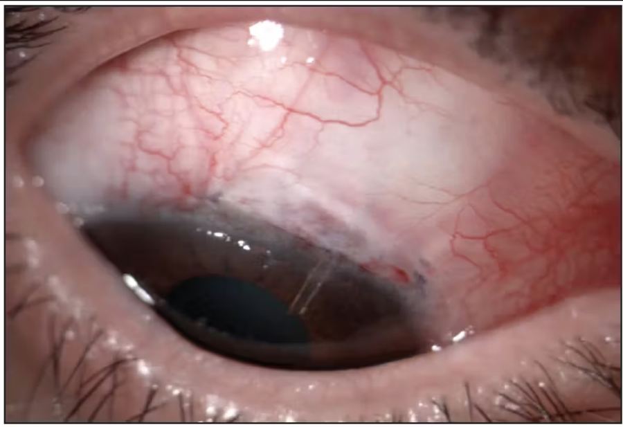 Microshunt for subconjunctival drainage in glaucoma surgery