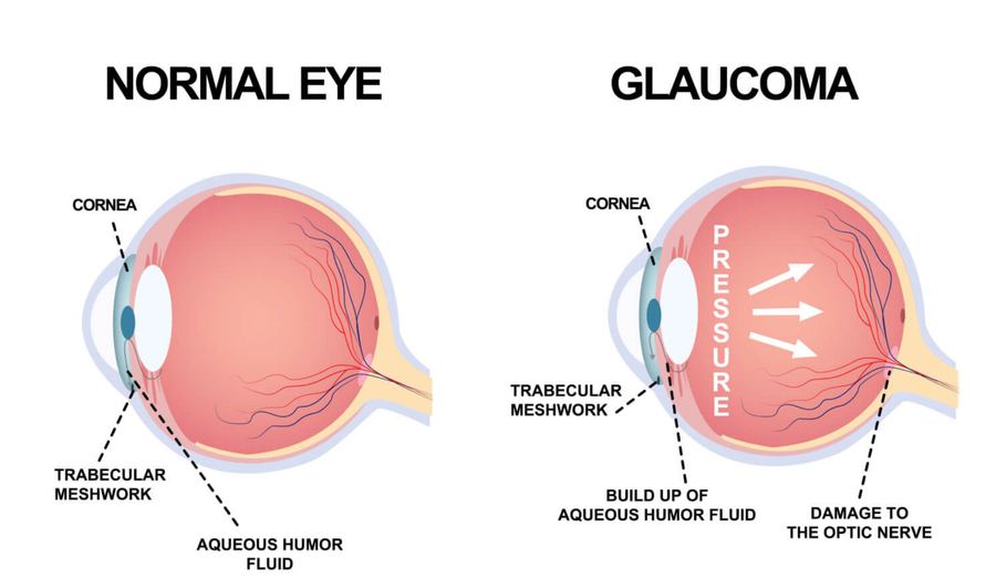 Anatomy of the eye's drainage system targeted by glaucoma surgery