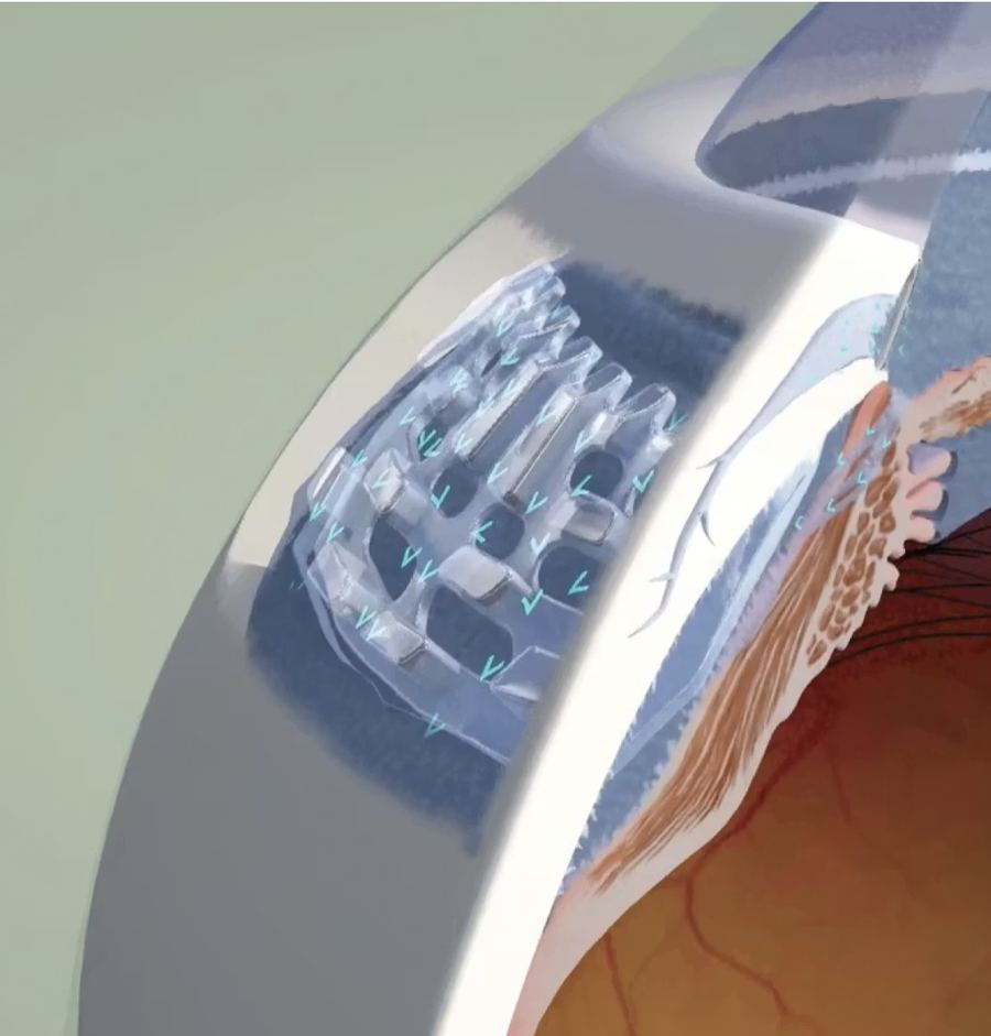 Next-generation glaucoma drainage implant