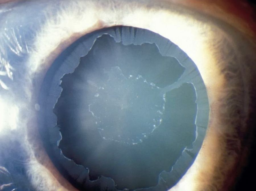 Gonioscopy view of the eye's drainage angle