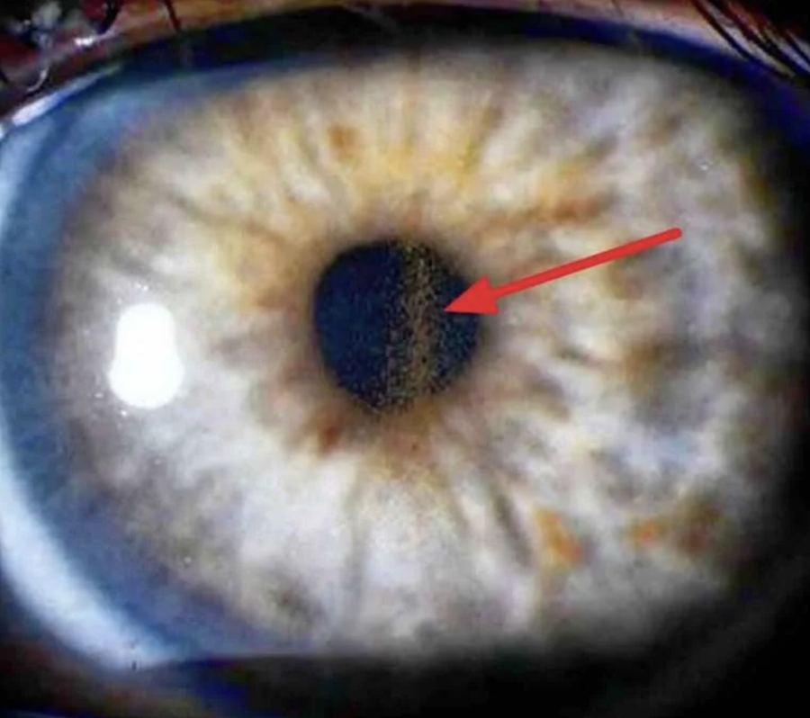 Gonioscopy view of the drainage angle with an area of concern