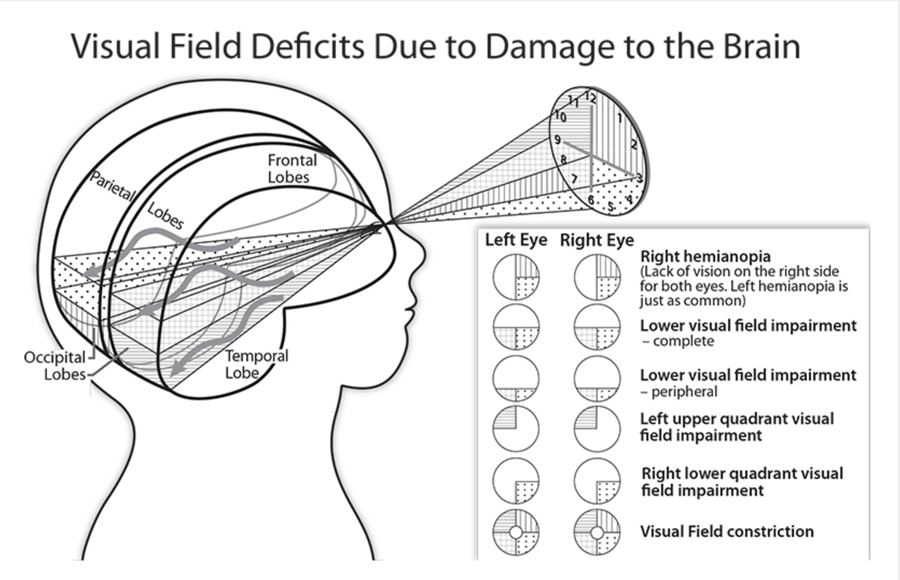 Visual field deficits caused by damage along the visual pathway