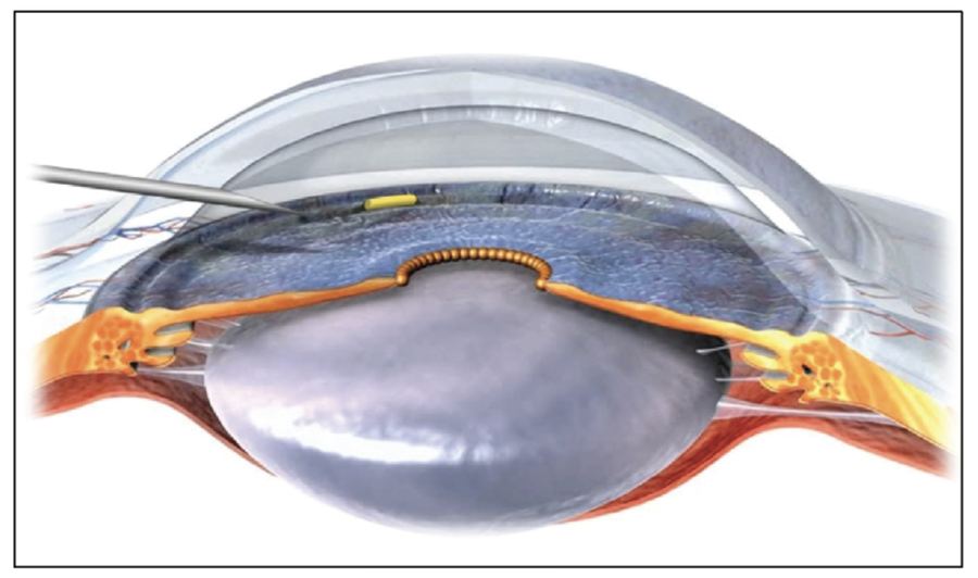 Gonioscopy close-up of the eye's drainage angle