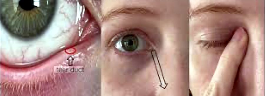 How to perform punctal (nasolacrimal) occlusion after glaucoma eye drops